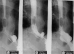 Inflammatory Polyp of the Esophagus